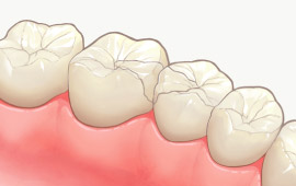 オールセラミックインレー