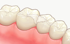 ジルコニアインレー