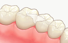 ハイブリッドレジンインレー