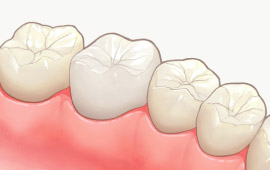 フルジルコニアクラウン